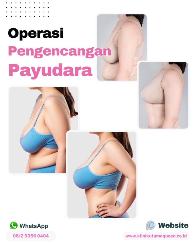Operasi pengencangan payudara